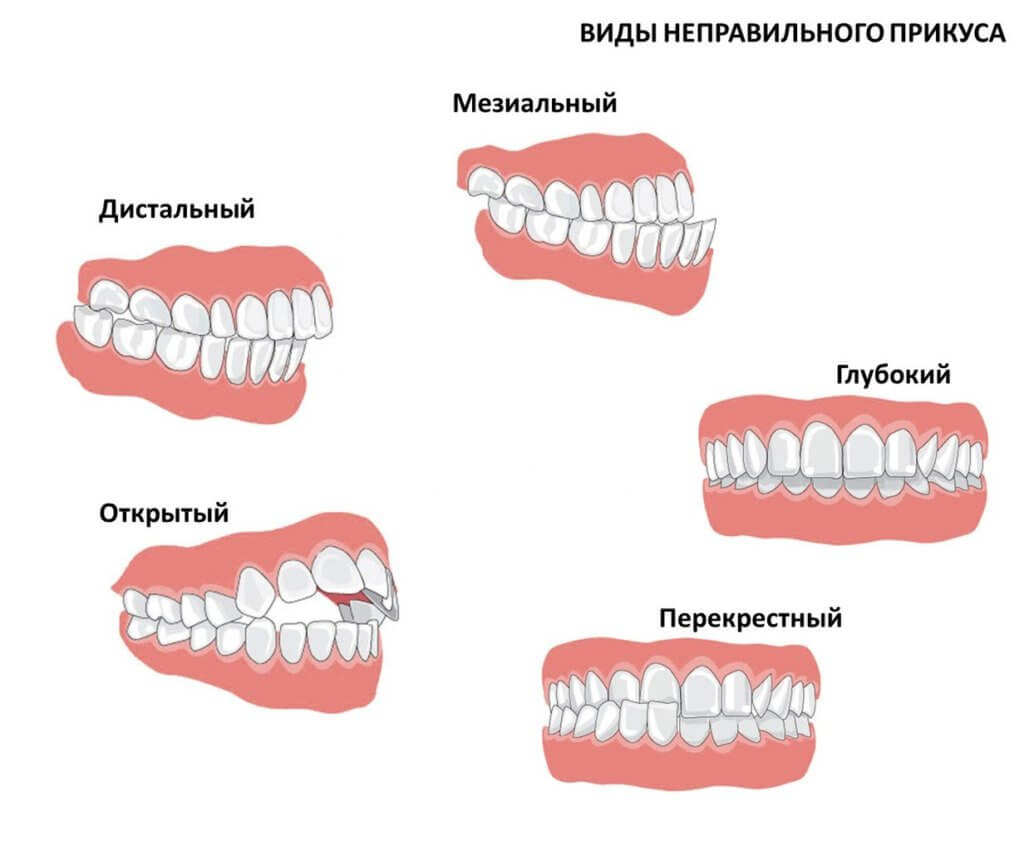 Правильная нижняя челюсть фото Постановка звука Р Дефектология Проф